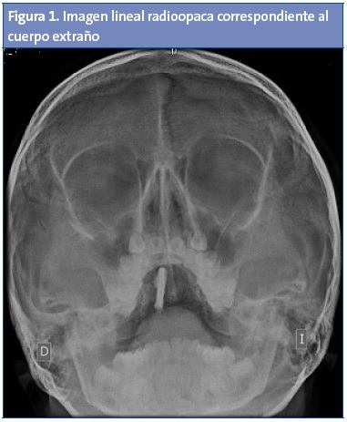 Figura 1. Imagen lineal radioopaca correspondiente al cuerpo extraño.