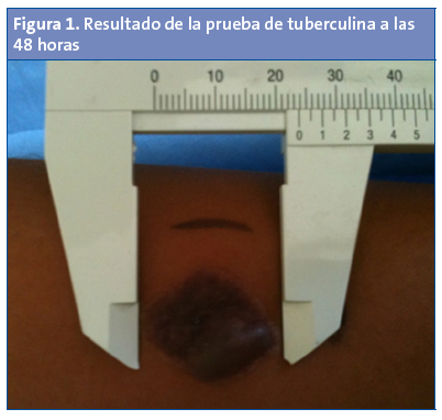 Figura 1. Resultado de la prueba de tuberculina a las 48 horas
