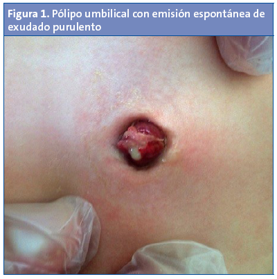 Figura 1. Pólipo umbilical con emisión espontánea de exudado purulento