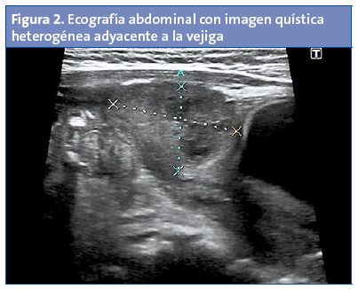 Figura 2. Ecografía abdominal con imagen quística heterogénea adyacente a la vejiga