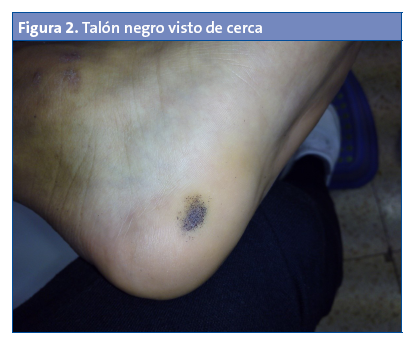 Talón negro visto de cerca.