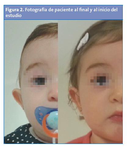 Figura 2. Fotografía de paciente al final y al inicio del estudio