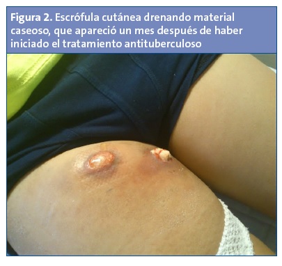 Figura 2. Figura 2. Escrófula cutánea drenando material caseoso, que apareció un mes después de haber iniciado el tratamiento antituberculoso