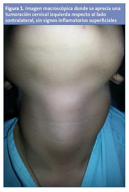 Figura 1. Imagen macroscópica donde se aprecia una tumoración cervical izquierda respecto al lado contralateral, sin signos inflamatorios superficiales.