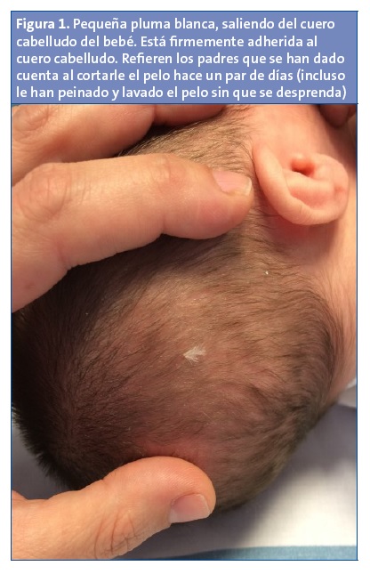 Figura 1. Pequeña pluma blanca, saliendo del cuero cabelludo del bebé. Está firmemente adherida al cuero cabelludo. Refieren los padres que se han dado cuenta al cortarle el pelo hace un par de días (incluso le han peinado y lavado el pelo sin que se desprenda).