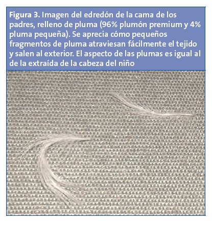 Figura 3. Imagen del edredón de la cama de los padres, relleno de pluma (96% plumón <em>premium</em> y 4% pluma pequeña). Se aprecia cómo pequeños fragmentos de pluma atraviesan fácilmente el tejido y salen al exterior. El aspecto de las plumas es igual al de la extraída de la cabeza del niño.