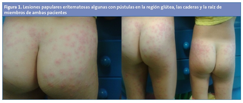 Figura 1. Lesiones papulares eritematosas algunas con pústulas en la región glútea, las caderas y la raíz de miembros de ambas pacientes.