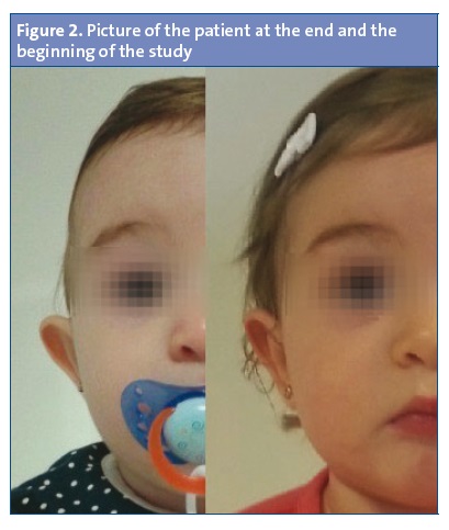 Figure 2. Picture of the patient at the end and the beginning of the study