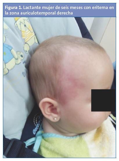 Figura 1. Lactante mujer de seis meses con eritema en la zona auriculotemporal derecha