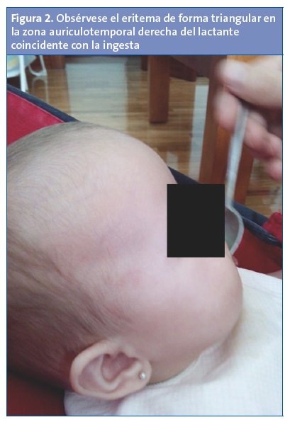 Figura 2. Obsérvese el eritema de forma triangular en la zona auriculotemporal derecha del lactante coincidente con la ingesta