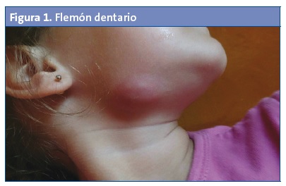 Figura 1. Flemón dentario