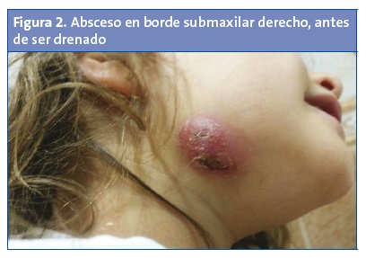 Figura 2. Absceso en borde submaxilar derecho, antes de ser drenado