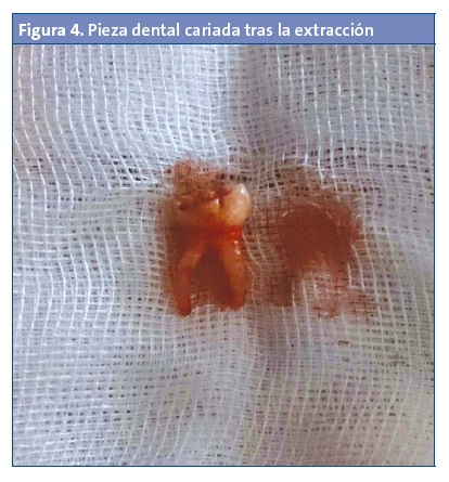Figura 4. Pieza dental cariada tras la extracción