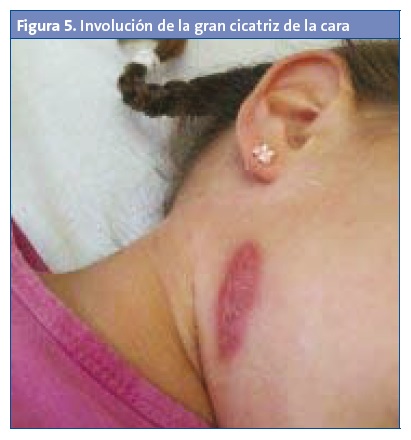 Figura 5. Involución de la gran cicatriz de la cara