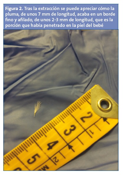 Figura 2. Tras la extracción se puede apreciar como la pluma, de unos 7 mm de longitud, acaba en un borde fino y afilado, de unos 2-3 mm de longitud, que es la porción que había penetrado en la piel del bebé.