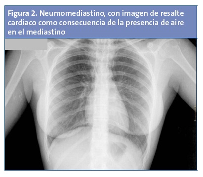 Figura 2. Neumomediastino, con imagen de resalte cardiaco como consecuencia de la presencia de aire en el mediastino