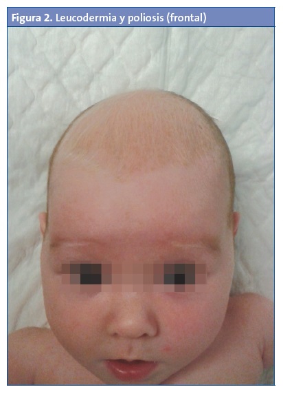 Figura 2. Leucodermia y poliosis (frontal)	
