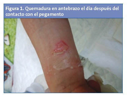 Figura 1. Quemadura en antebrazo el día después del contacto con el pegamento