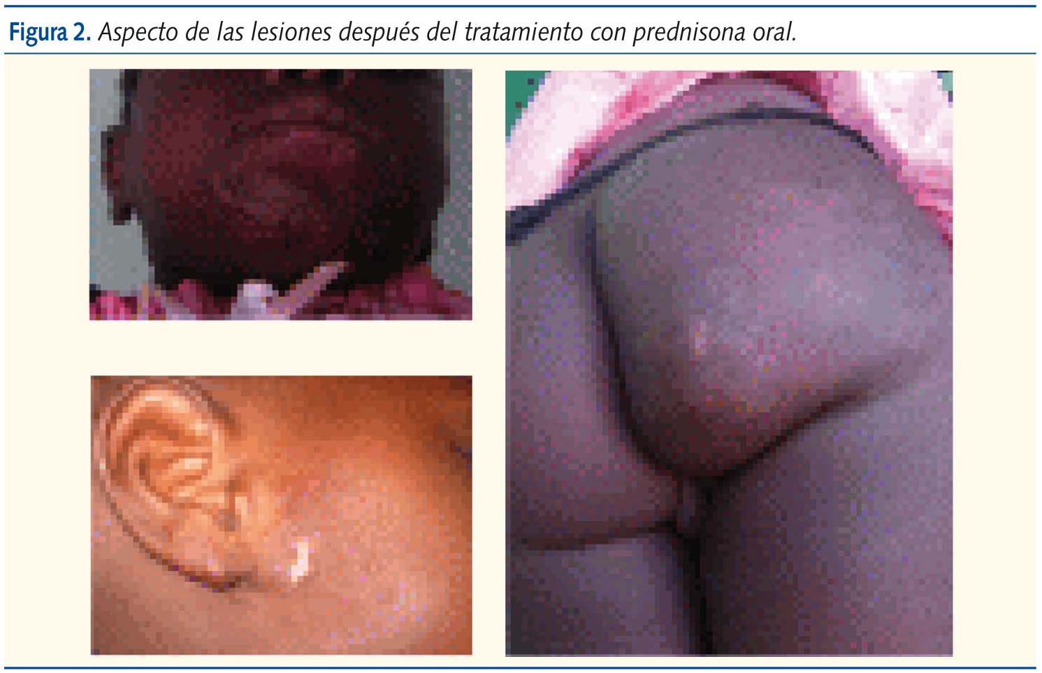 Figura 2. Aspecto de las lesiones después del tratamiento con prednisona oral.
