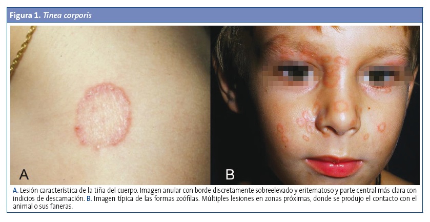 Figura 1. Tinea corporis