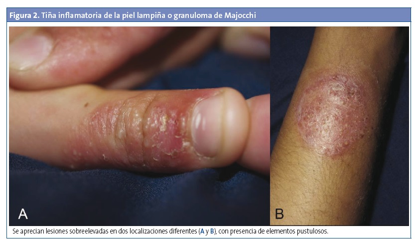 Figura 2. Tiña inflamatoria de la piel lampiña o granuloma de Majocchi