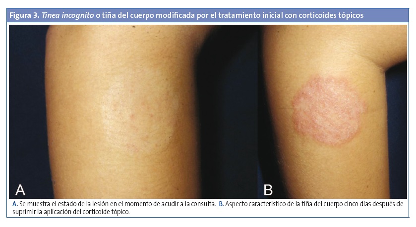 Figura 3. Tinea incognito o tiña del cuerpo modificada por el tratamiento inicial con corticoides tópicos