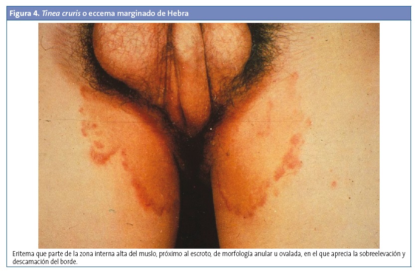 Figura 4. Tinea cruris o eccema marginado de Hebra