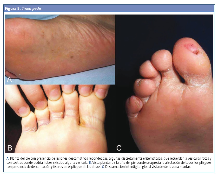 Figura 5. Tinea pedis