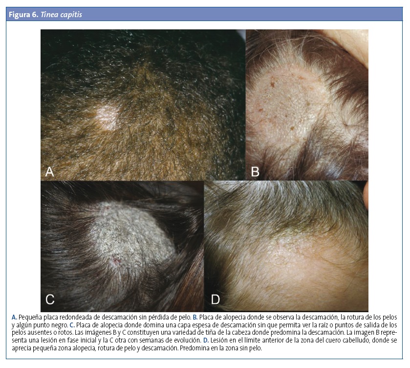 Figura 6. Tinea capitis