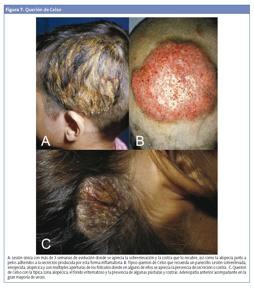Figura 7. Querión de Celso