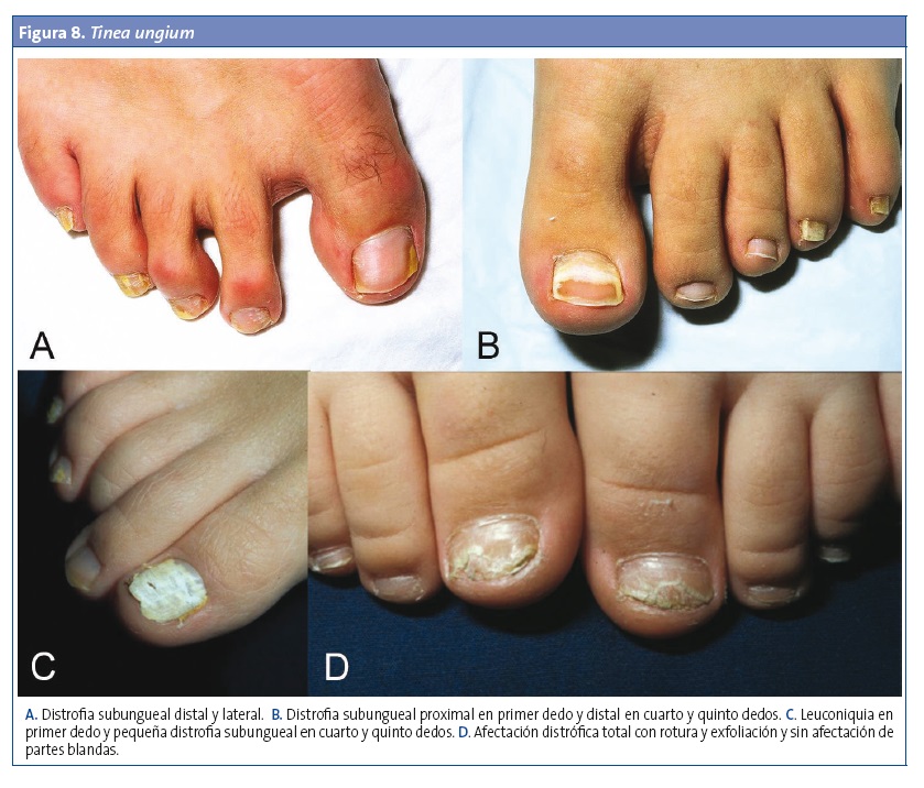 Figura 8. Tinea ungium