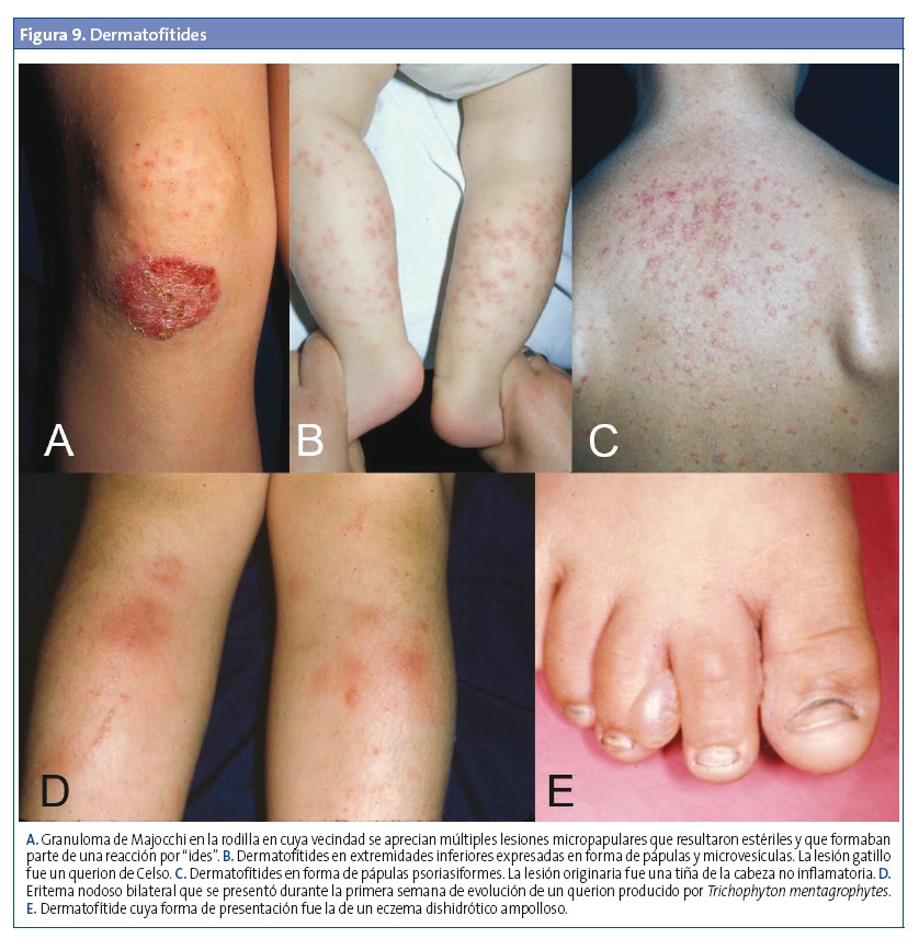 Figura 9. Dermatofítides