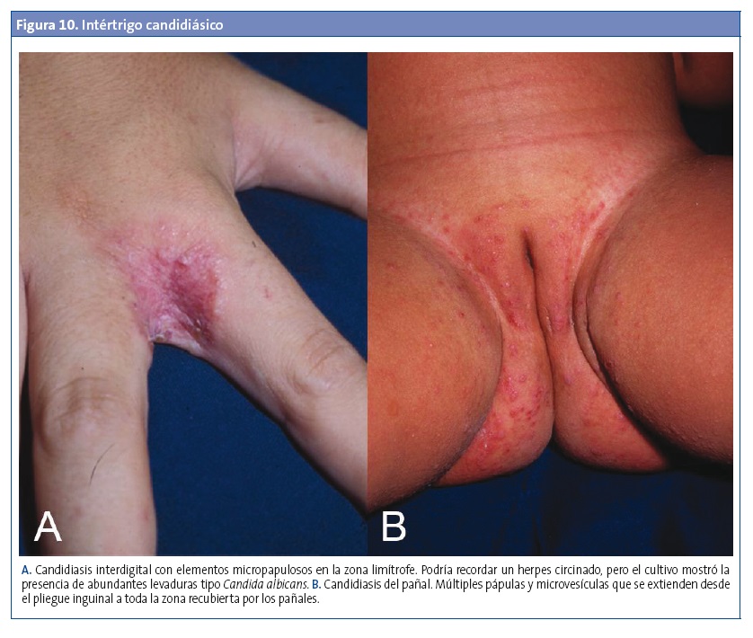 Figura 10. Intértrigo candidiásico