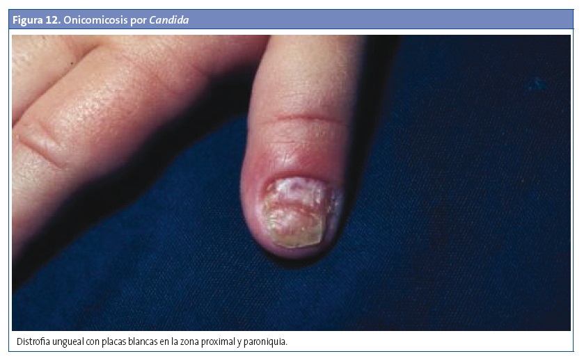 Figura 12. Onicomicosis por Candida