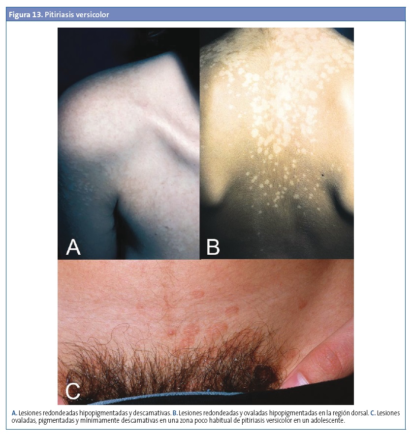 Figura 13. Pitiriasis versicolor
