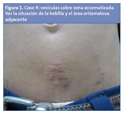 Figura 1. Caso 9: vesículas sobre zona eccematizada. Ver la situación de la hebilla y el área eritematosa adyacente