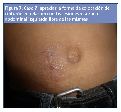 Figura 7. Caso 7: apreciar la forma de colocación del cinturón en relación con las lesiones y la zona abdominal izquierda libre de las mismas	