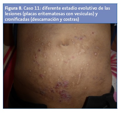 Figura 8. Caso 11: diferente estadio evolutivo de las lesiones (placas eritematosas con vesículas) y cronificadas (descamación y costras)