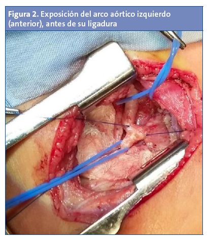 Figura 2. Exposición del arco aórtico izquierdo (anterior), antes de su ligadura