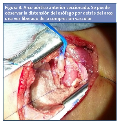 Figura 3. Arco aórtico anterior seccionado. Se puede observar la distensión del esófago por detrás del arco, una vez liberado de la compresión vascular