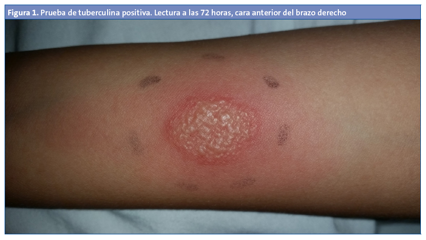 Figura 1. Prueba de tuberculina positiva. Lectura a las 72 horas, cara anterior del brazo derecho