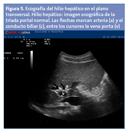 Figura 5. Ecografía del hilio hepático en el plano transversal. Hilio hepático: imagen ecográfica de la tríada portal normal. Las flechas marcan arteria (a) y el conducto biliar (c), entre los cursores la vena porta (v)