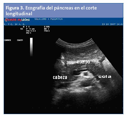 Figura 3. Ecografía del páncreas en el corte longitudinal