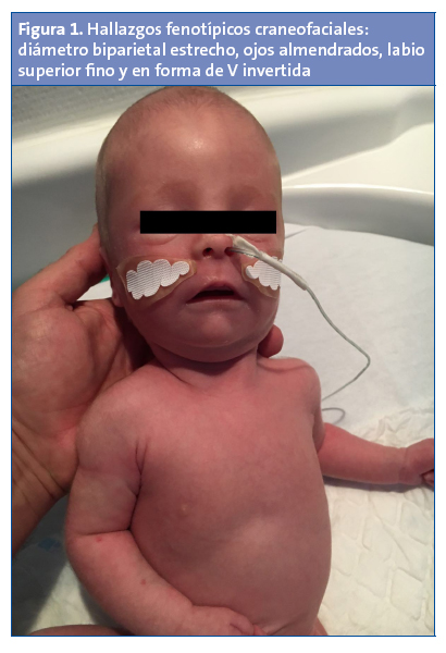 Figura 1. Hallazgos fenotípicos craneofaciales: diámetro biparietal estrecho, ojos almendrados, labio superior fino y en forma de V invertida