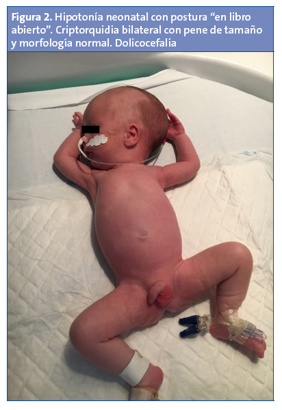 Figura 2. Hipotonía neonatal con postura “en libro abierto”. Criptorquidia bilateral con pene de tamaño y morfología normal. Dolicocefalia