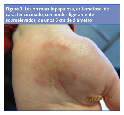 Figura 1. Lesión maculopapulosa, eritematosa, de carácter circinado, con bordes ligeramente sobreelevados, de unos 5 cm de diámetro