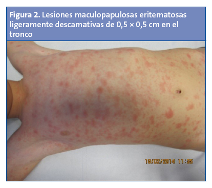 Figura 2. Lesiones maculopapulosas eritematosas ligeramente descamativas de 0,5 × 0,5 cm en el tronco