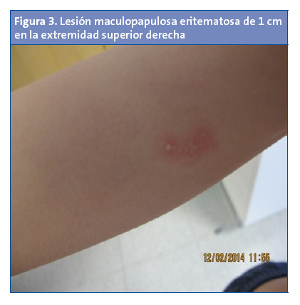 Figura 3. Lesión maculopapulosa eritematosa de 1 cm en la extremidad superior derecha