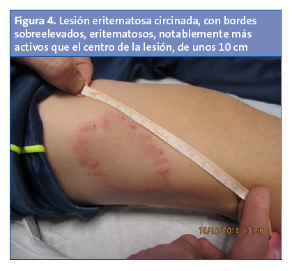 Figura 4. Lesión eritematosa circinada, con bordes sobreelevados, eritematosos, notablemente más activos que el centro de la lesión, de unos 10 cm
