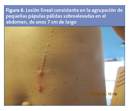 Figura 6. Lesión lineal consistente en la agrupación de pequeñas pápulas pálidas sobreelevadas en el abdomen, de unos 7 cm de largo